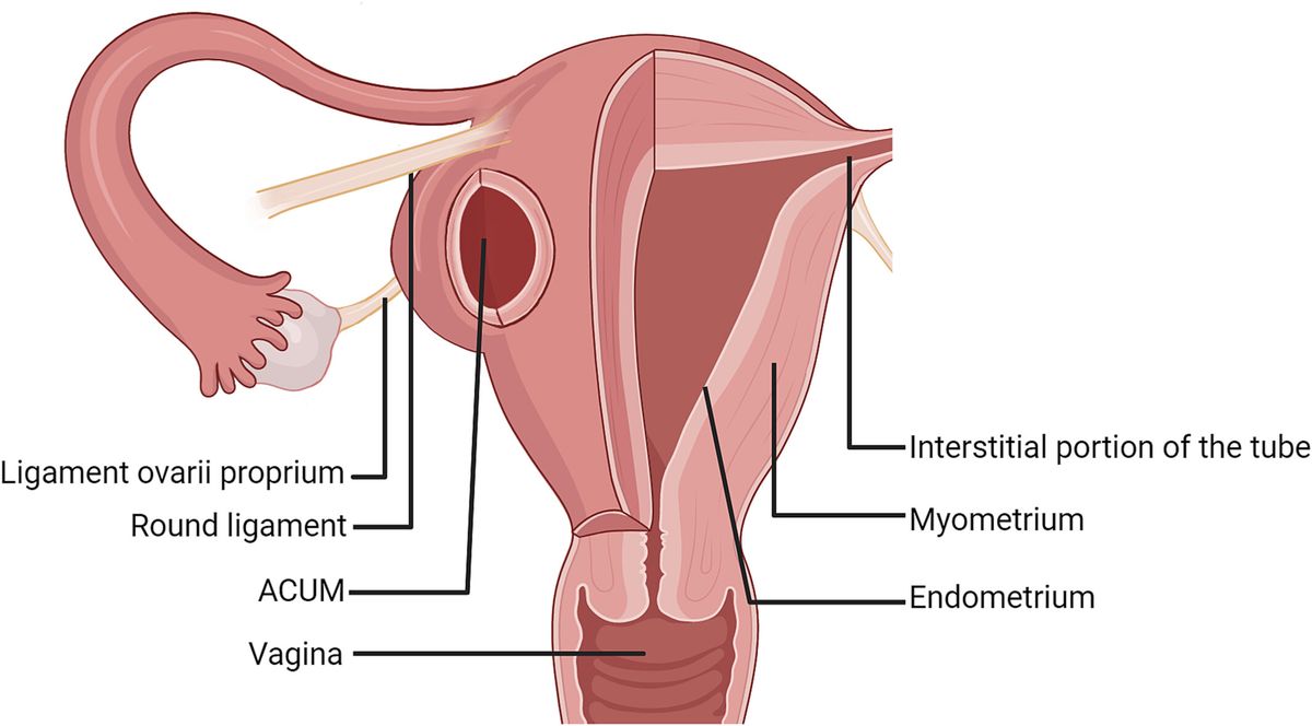 Accessory Cavitated Uterine Mass