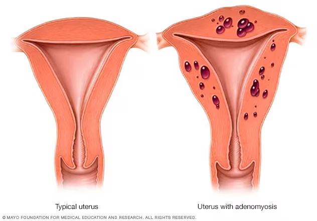 Adenomyosis shown within the muscular wall of the uterus.