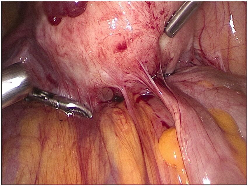 Surgical adhesions