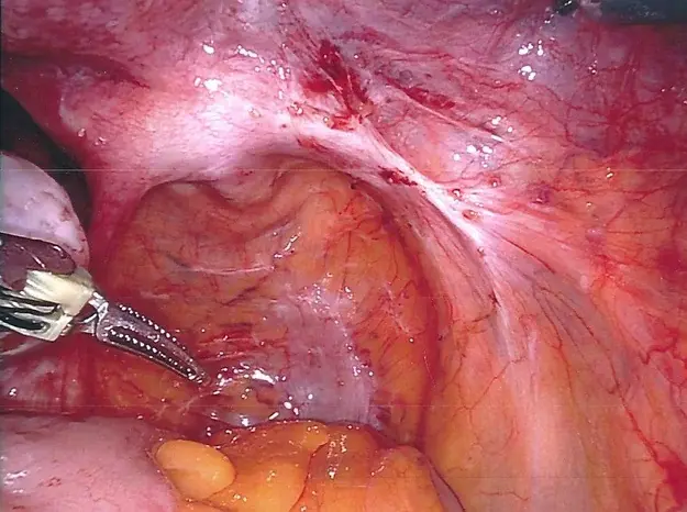 Endometriosis deposits seen at laparoscopy