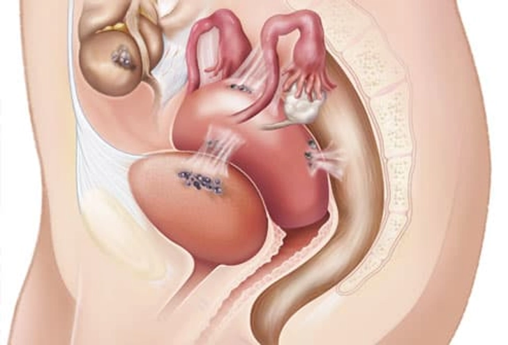 Endometriosis deposits throughout the pelvis