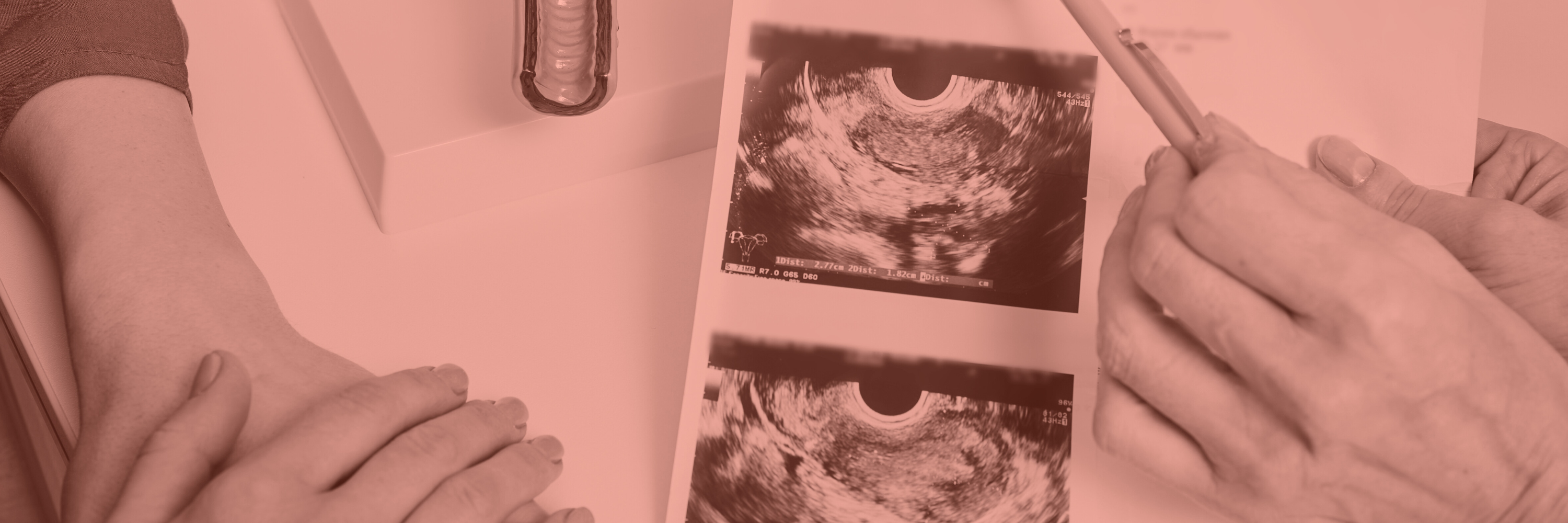 Ultrasound images printed on thermal paper